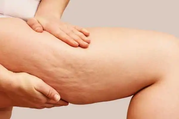 Image of woman showing leg with cellulite Swadlincote