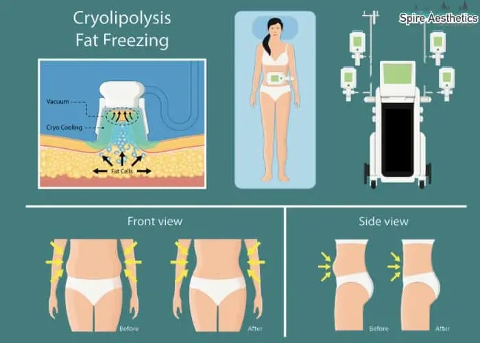 Fat freezing treatment Swadlincote benefits for competitions to remove stubborn fat deposits.