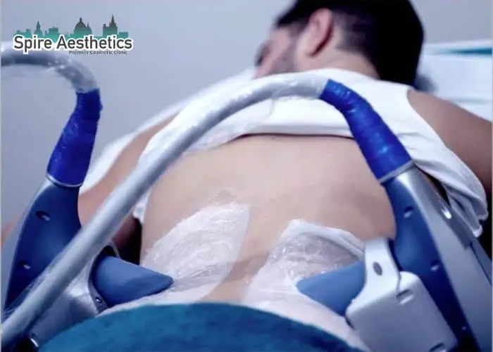 Man having fat freezing treatment done on love handles before a competitions Swadlincote to create a sculpted look.