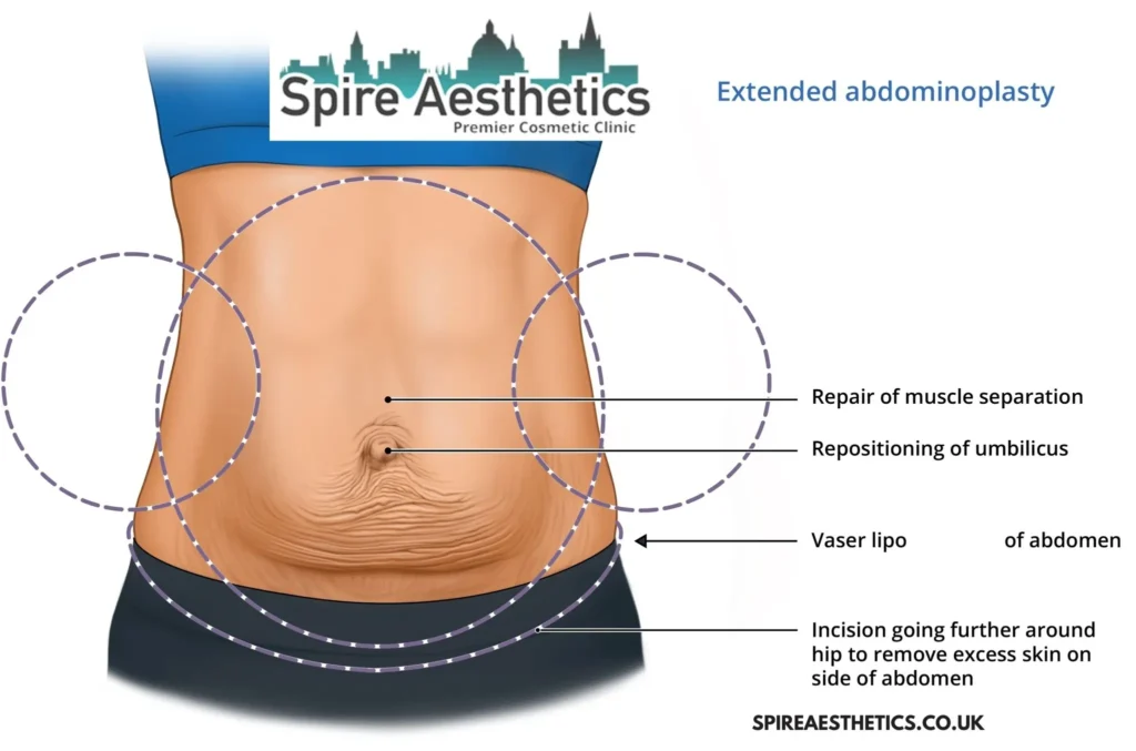 Understanding Loose Skin After Gastric Band Swadlincote Surgery and HIFU Treatment