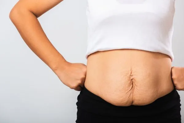Image of a woman's stomach after weight loss with sagging skin following a gastric band Swadlincote