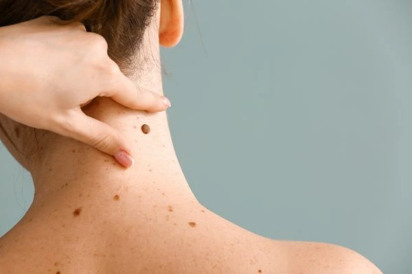 skin blemish removal Swadlincote treatment